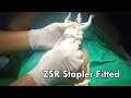 zsr circumcision surgery stitchless circumcision painless procedure in vesu majuragate surat