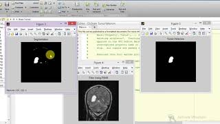 Brain Tumor Detection and Classification using Image Processing Matlab Project with Source Code
