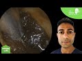 1,283 - Ear Ache Ear Wax Removal - 2 Cases