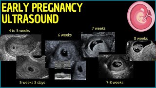 Early Pregnancy Ultrasound: A Deep Dive into First Trimester Insights #pregnancyultrasound