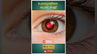 ഫോട്ടോകളിലെ പ്രേതകണ്ണ് | red eye #shorts