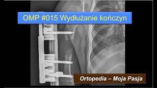 Wydłużanie kończyn - fakty i... fakty | OMP#015