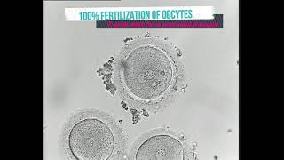 100% Fertilization in ICSI | The first step to successful IVF result | Fertilization check by 2PN