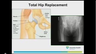 Learn about Total Hip Replacement - Essentia Health