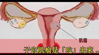 子宮肌瘤是「吃」出來的！這「4種食物」別碰, 女人快為自己收藏！