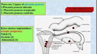 18 Normal and Abnormal Sites of Implantation