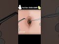 ASMR | Remove Huge Navel Stone Animation