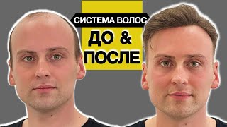 Жизнь в системе волос несколько лет, заметно ли? Ассортимент систем волос при алопеции у мужчин.