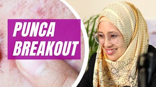 5 Punca Muka BREAKOUT Yang Ramai Tak Tahu