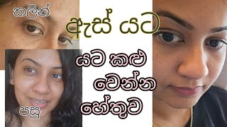 ඇස් යට ඇත්තටම කලු වෙන්න හේතුව ඉක්මනින්ම ඇස් යට කලු පැහැය නැති කරගමු