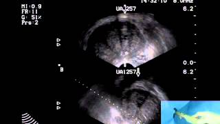 Transrectal Ultrasound Prostate Biopsy - Periprostatic Nerve Block