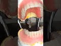 appareille dentaire totale p.a.t dental dentist montage dental