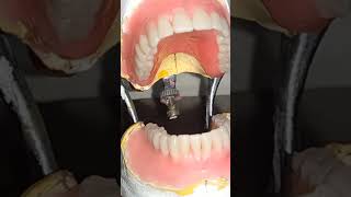 Appareille dentaire totale #P.A.T #dental #dentist #montage #dental