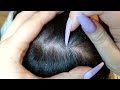 SCALP SCRATCHING, Dandruff Removal, No talking ASMR.