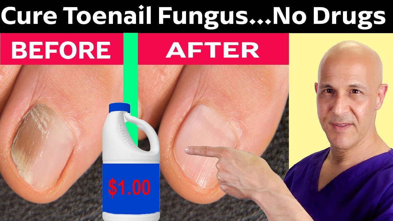 How To Cure Toenail Fungus For Pennies A Day! Dr. Mandell - YouTube