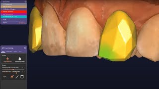 Crystal cut Grillz for Expert Mode in Exocad