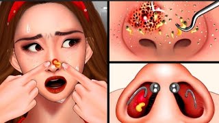 ASMR Remove pus animation ASMR Nose Blackheads Removal & Nose Piercing Cleaning | ASMR Treatment