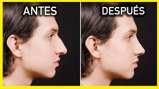 NOSE JOB BEFORE AND AFTER | RHINOPLASTY BEFORE AND AFTER