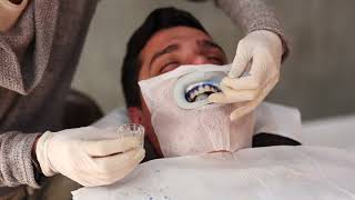 YoTuel Step by Step in-office tooth whitening treatment trailer