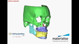 Digitale planning osteotomie - schedel en kaken na operatie.