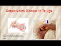 Dequervains Disease In Telugu