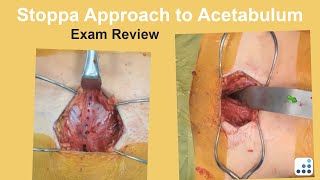 Stoppa Approach to Acetabulum Exam Review - Ben Taylor, MD