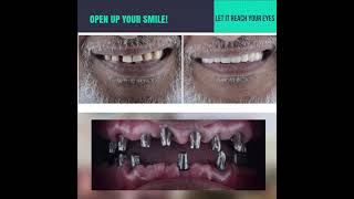 Full mouth Rehabilitation| We Dental| Best Dental| Coimbatore| Immediate Implants| Dr Arshad|72hours