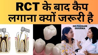 रूट कैनाल (RCT) के बाद कैप लगाना क्यों जरुरी है | Cap After Root Canal Treatment