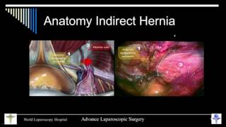 Totally Extraperitoneal Repair of Hernia Lecture by Dr R K Mishra
