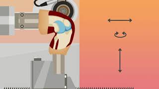 To repair or not to repair: A biomechanics study of meniscal ramp lesions