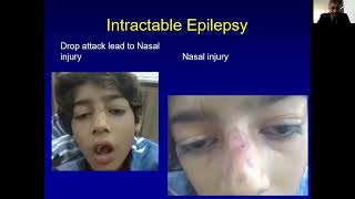 Selection of AED In Childhood Epilepsy By Dr Tipu Sultan