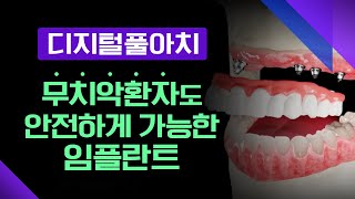 무치악 환자도 안전하게 임플란트 수술을 할 수 있다! '디지털풀아치' [ 메디컬다큐365 ] 20240304