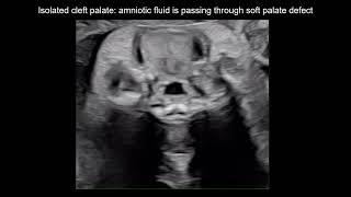 Videoclip from #uogjournal distinguishes submucous cleft palate from isolated cleft palate