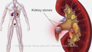 Calcification in Your Body