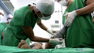 Brazilian doctors use fish skin to treat burns