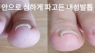 [시원함주의!!]😨안쪽으로 박혀버린 내성발톱 교정영상!!교정 끝나고 너무 좋아하심!!👍😄(ingrown toenail/toenails with fungus)