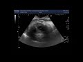 ultrasound video showing fetal hydrocephalus due to ventriculomegaly.