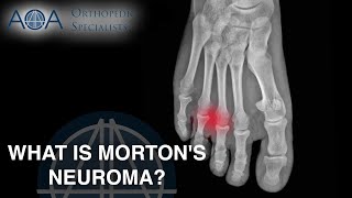 AOA Orthopedic Specialists - What is Morton's Neuroma?