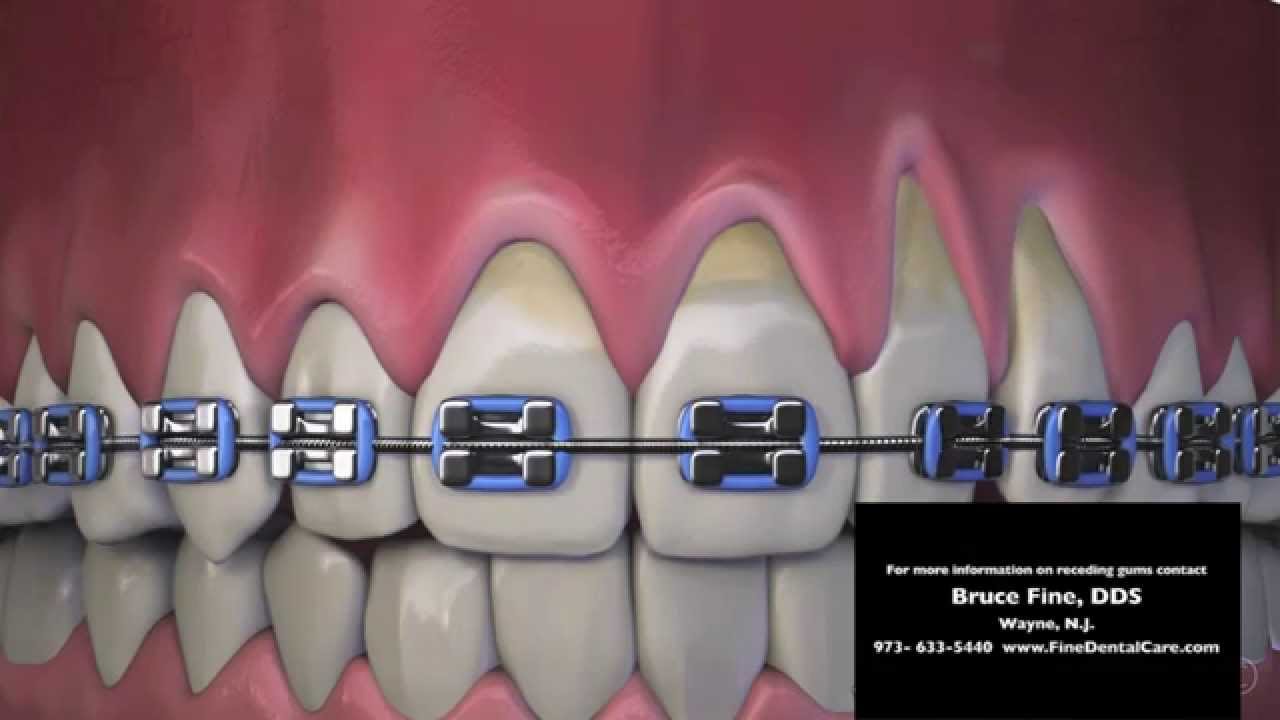 Receding Gums New Jersey Dentist Shows How Braces May Cause Recession ...