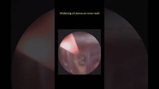 Suprasellar Arachnoid Cyst Neuroendoscopic Treatment #brain #endoscopy #hydrocephalus