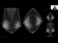 AI in Breast Imaging: An Asian Perspective