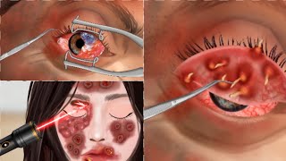 ASMR | Eye Remove Big Callous &Genital Warts Infected | Face DeepCleaning Animation | asmr animation