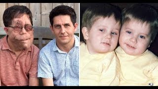 Adam and Neil Pearson are  twins born with the same genetic disease that has left one with  memory l