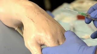 How to Insert a Peripheral IV | Merck Manual Professional Version