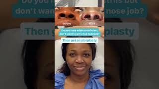 ALARPLASTY BEFORE AND AFTER - JANJUA FACIAL SURGERY - NEW JERSEY