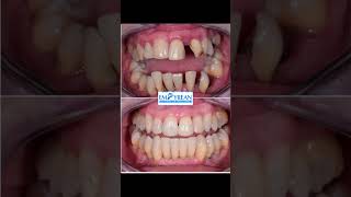 Treatment of Pyorrhea | Pyorrhea ka illaj | periodontitis #shorts #viralvideo #trending #pyorrhea