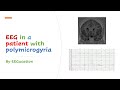 EEG in a Patient with Polymicrogyria