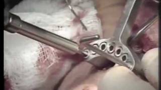 Surgical Insertion of the Staple Implant