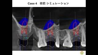 【手術動画】ソケットリフト術式 CASE.04