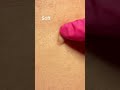 Neurofibroma Removal #shorts | SkinByDrAzi